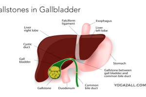 Gallstone in Gallbladder