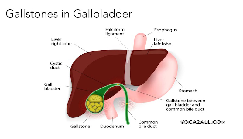 Gallstone in Gallbladder