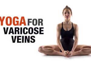 Varicose veins and yoga