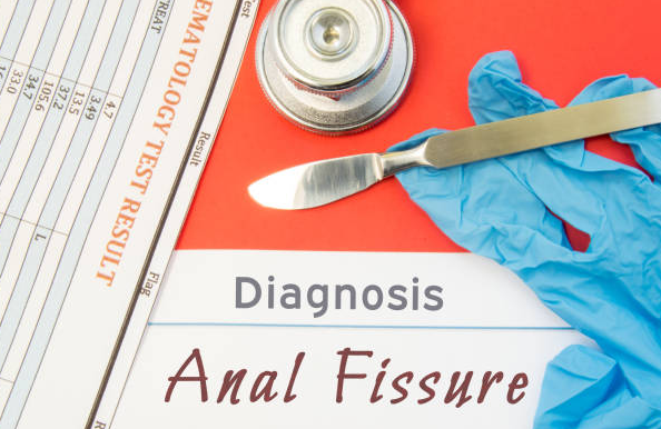 Anal fissure