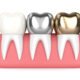 Importance of Dental Fillings or Dental Restoration