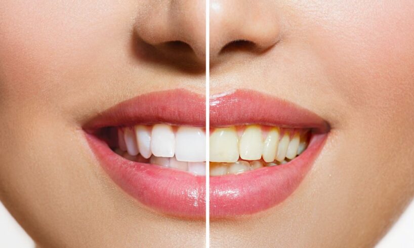 Teeth staining benefits